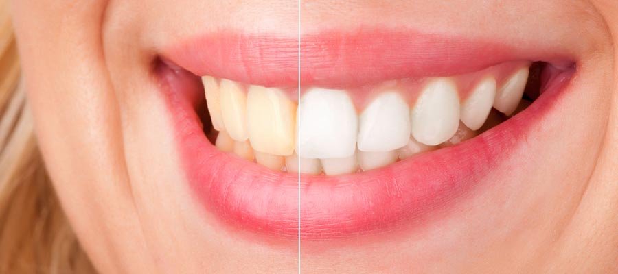 Laser Teeth Whitening Treatment