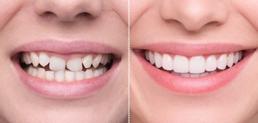Cosmetic Dentistry and Smile Design Makeovers