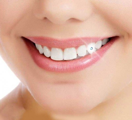 Tooth Jewelry Bonding Cosmetic Procedure