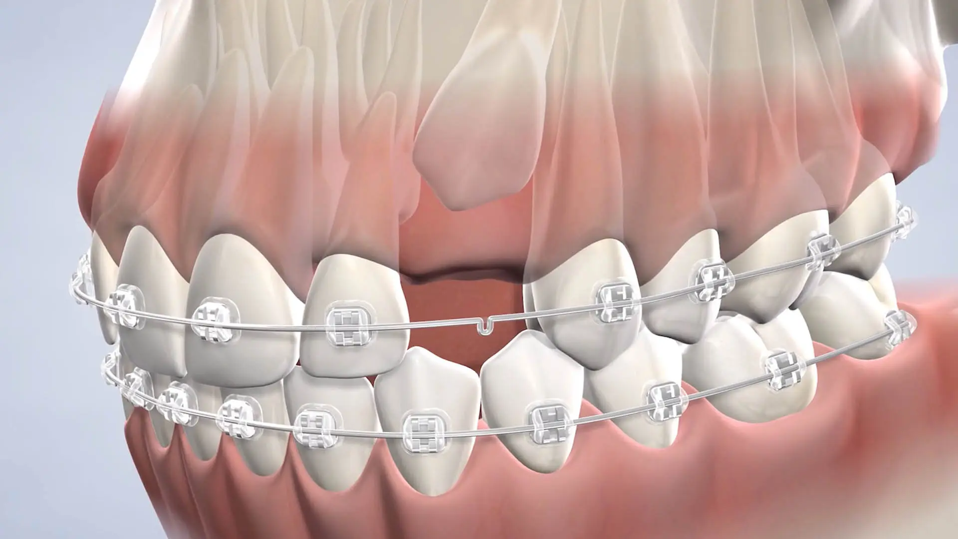 Surgical Canine Exposure for Braces Treatment