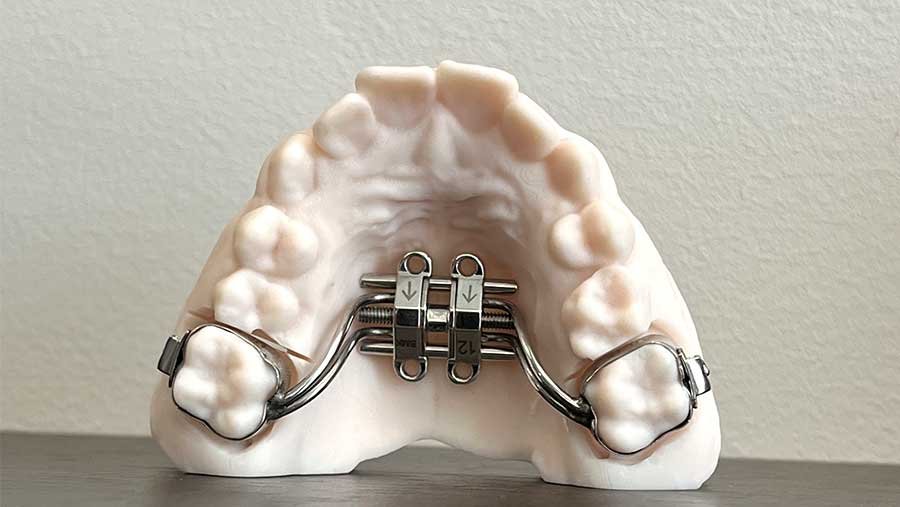 Maxillary Skeletal Expander (MSE)