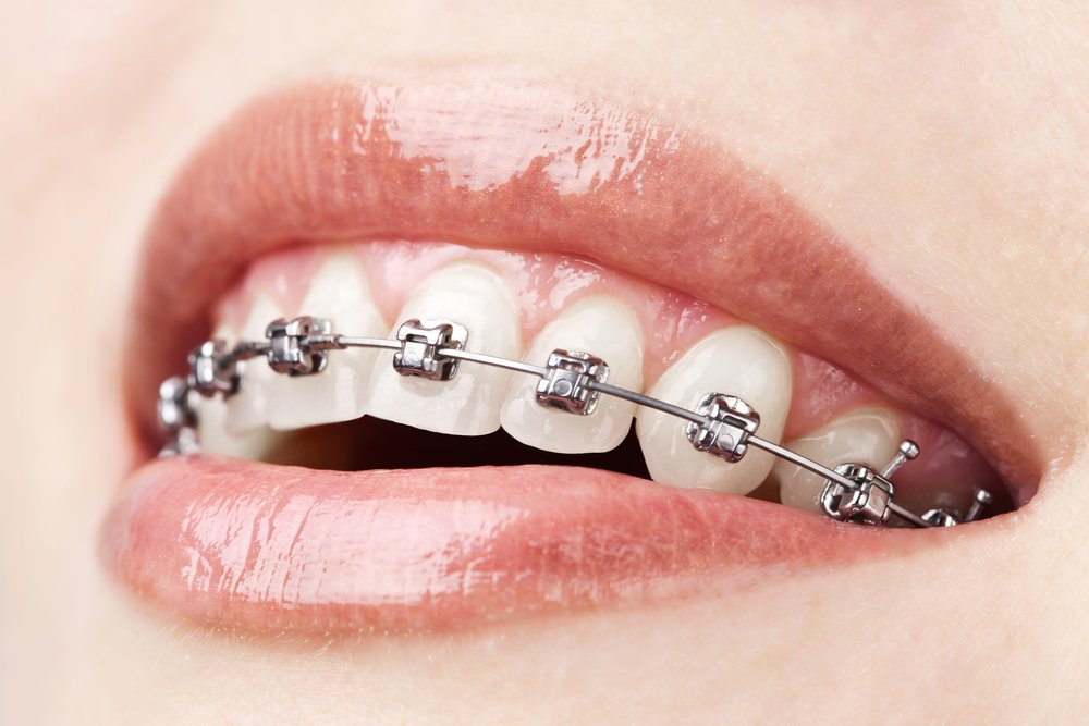 Self-Ligating Braces