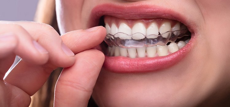 Preventive Night Guards and Custom Mouthguards