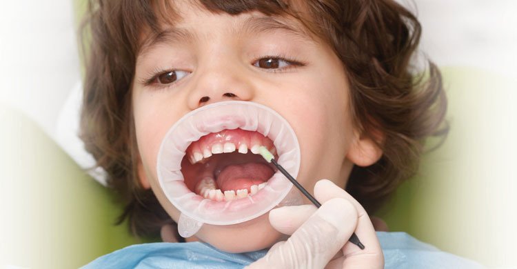 Professional Fluoride Application for Cavity Prevention