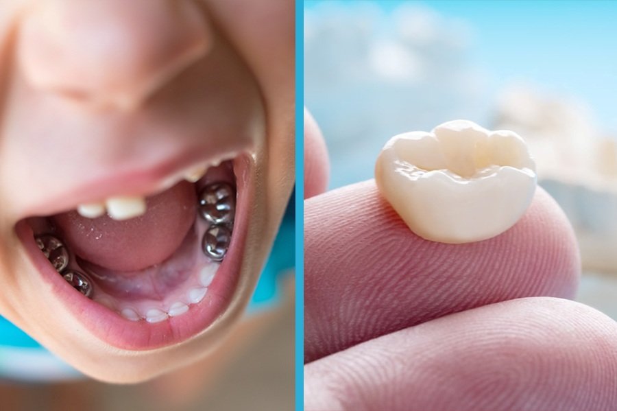 Kids Crown (Tooth Coloured & Metal)
