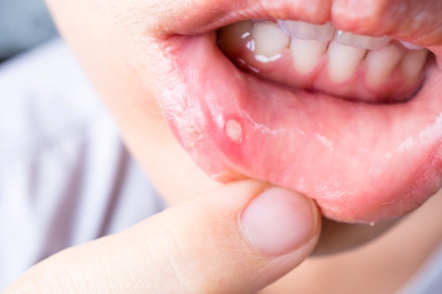 Treatment for Mouth Ulcers & Sensitivity