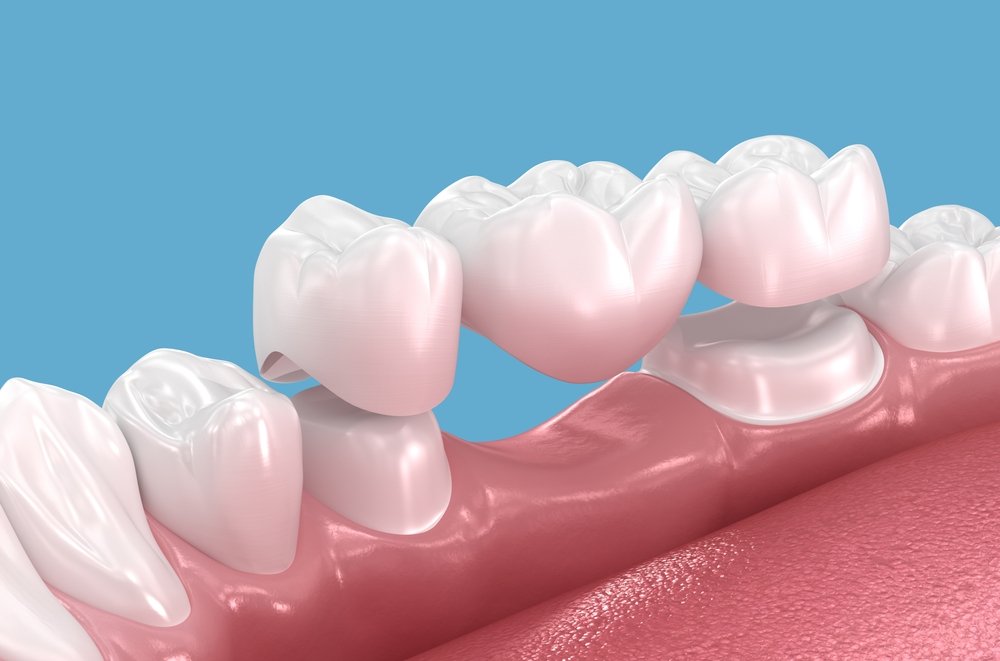 Dental Crowns and Bridges Restoration