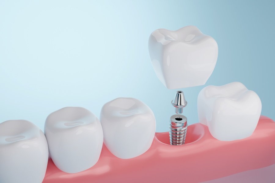 Dental Implant Tooth Replacement