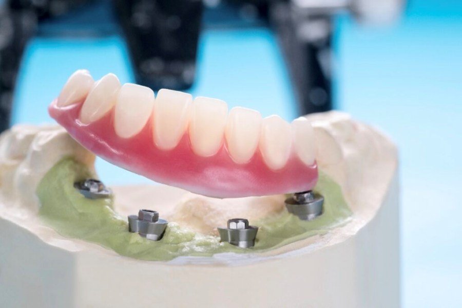 Implant-Supported Overdentures