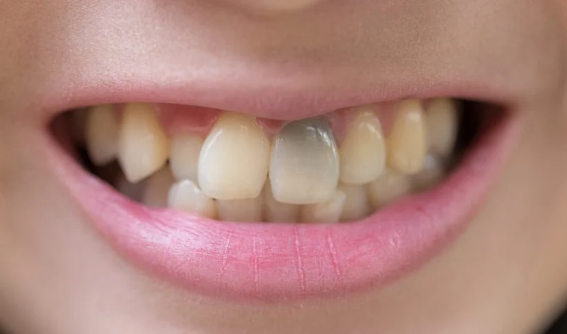 Internal Tooth Bleaching for Discolored Teeth