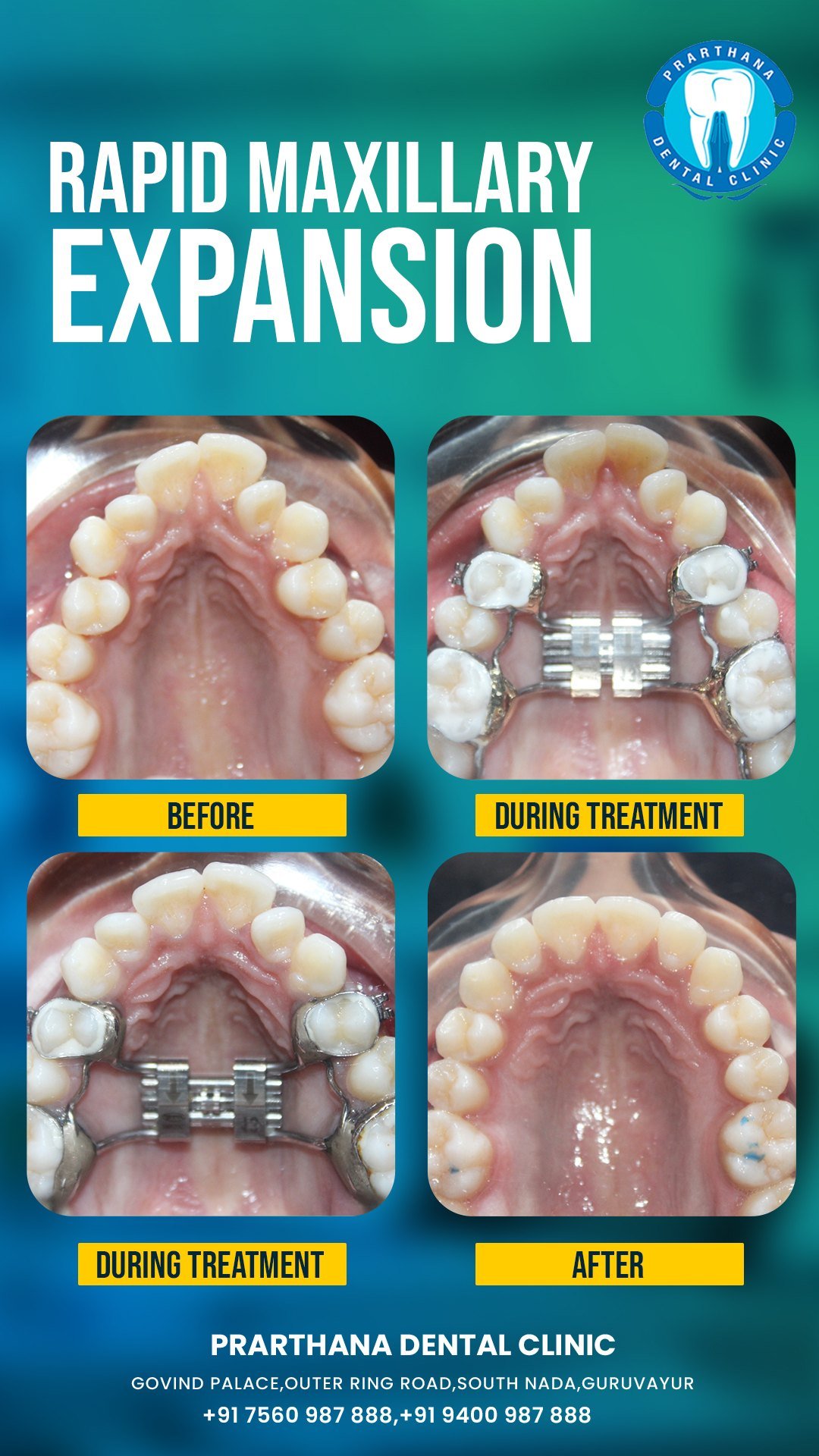 Smile Makeover & Correction Case