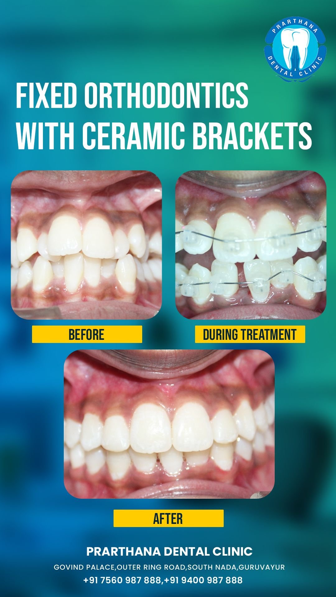 Symmetrical Tooth Correction Case