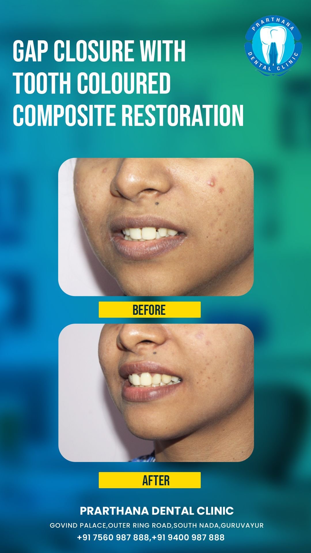 Advanced Dental Restoration Case