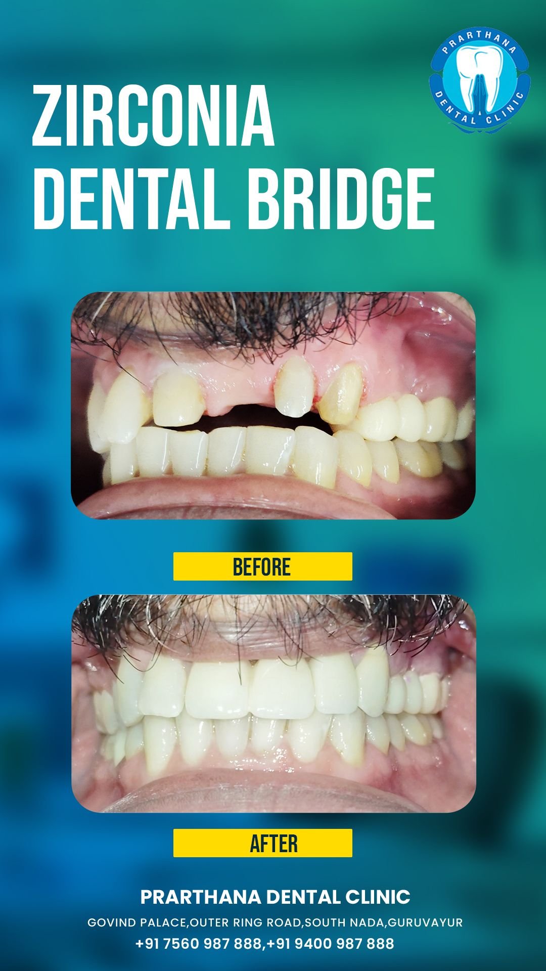 Premium Cosmetic Veneers Case