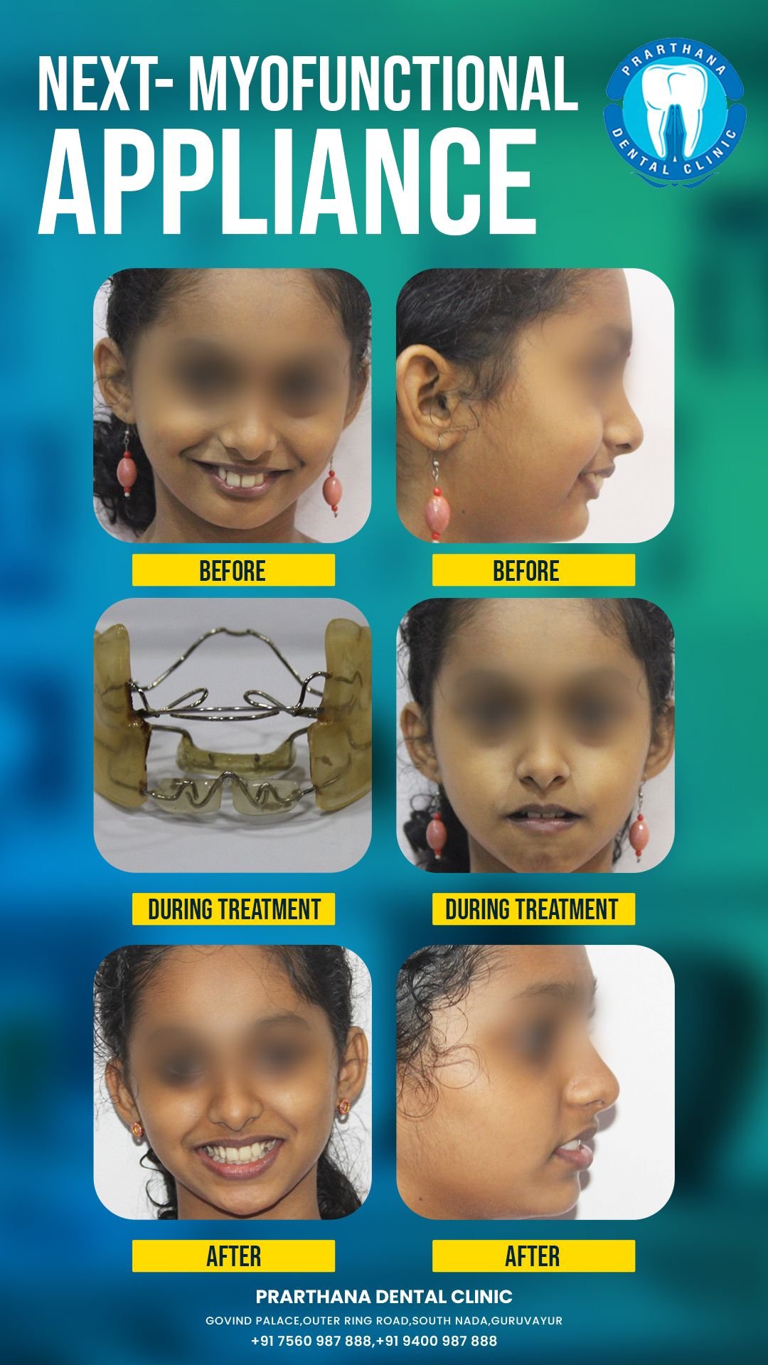 Teeth Whitening and Restoration Case